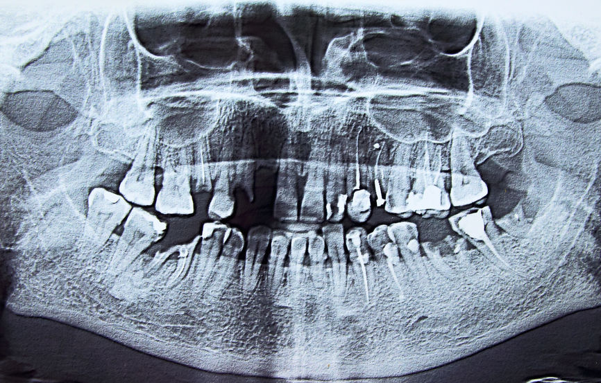 Full Mouth Reconstruction