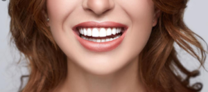 Porcelain Veneers