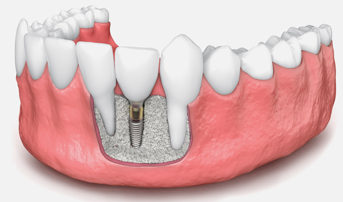 Dental Bone Grafting