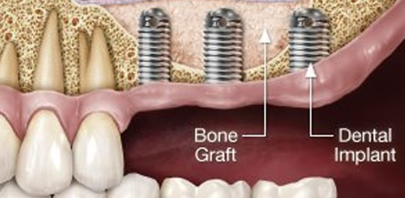 Dental Bone Grafting