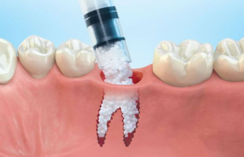 Dental Bone Grafting