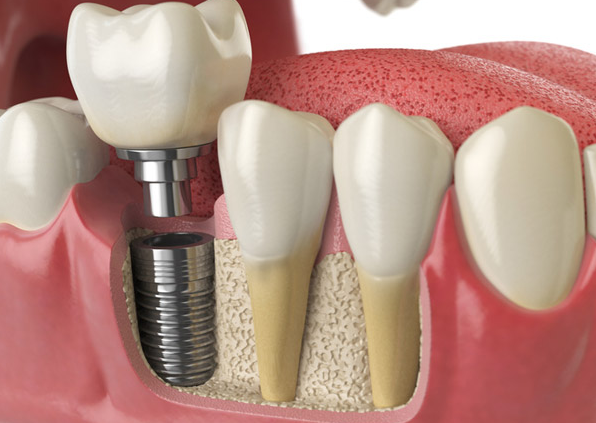 Dental Bone Grafting