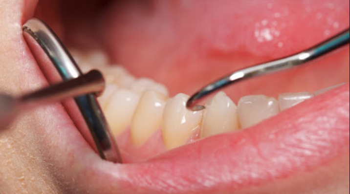Read more about the article RECEDING GUMS: CAUSES, TREATMENT, SURGERY, AND PREVENTION