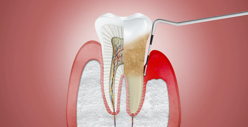 Receding Gums