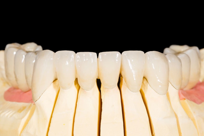 Read more about the article DENTAL VENEERS – USES, PROCEDURE, AND MORE