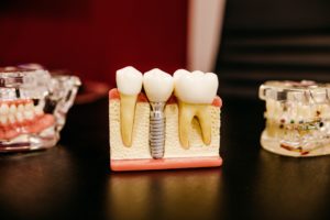 Read more about the article What Are Dental Implants For Dentures?