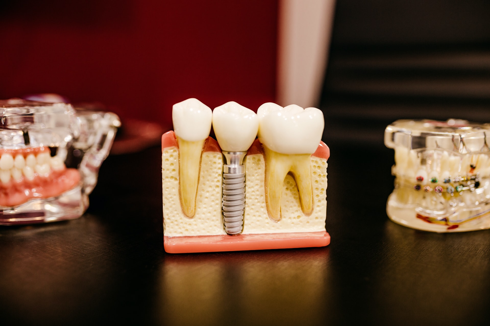You are currently viewing What Are Dental Implants For Dentures?