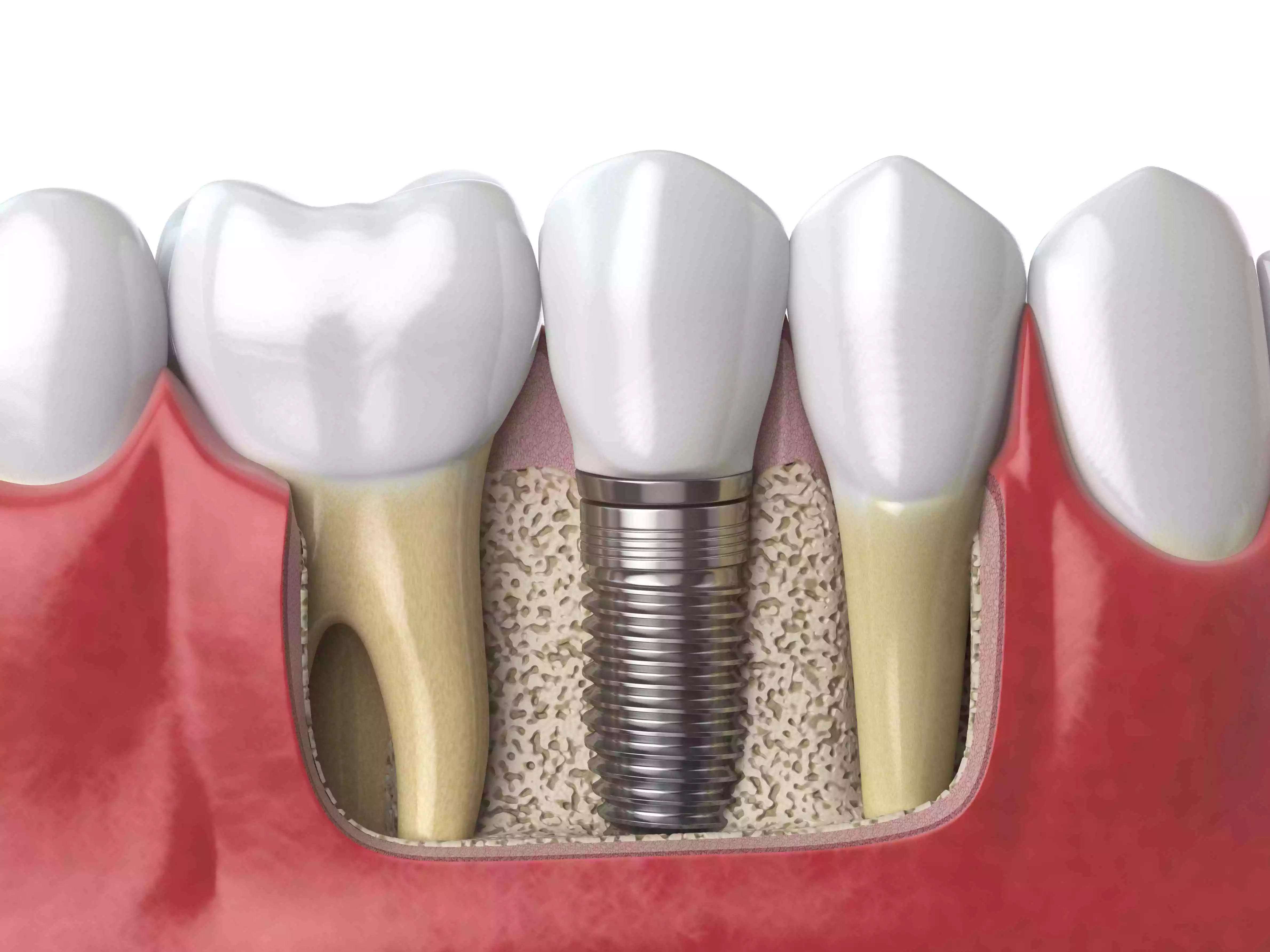 You are currently viewing Dental Implant Procedure