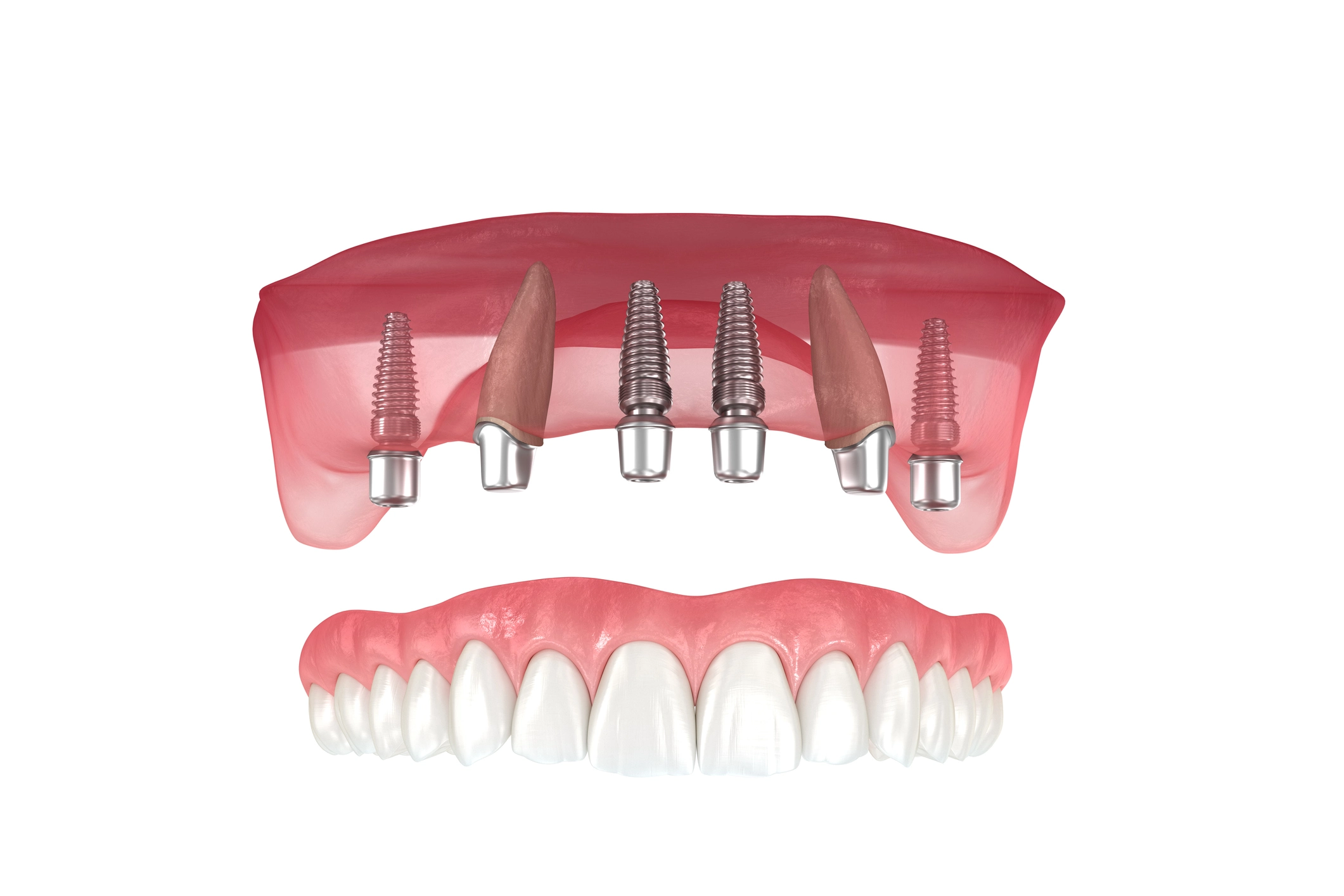All On Four Dental Implants