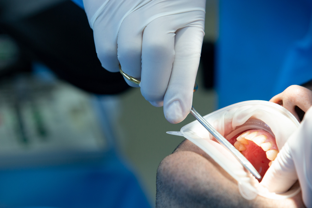 Read more about the article Dental Bone Graft Procedure Guide: What to Expect Before, During and After