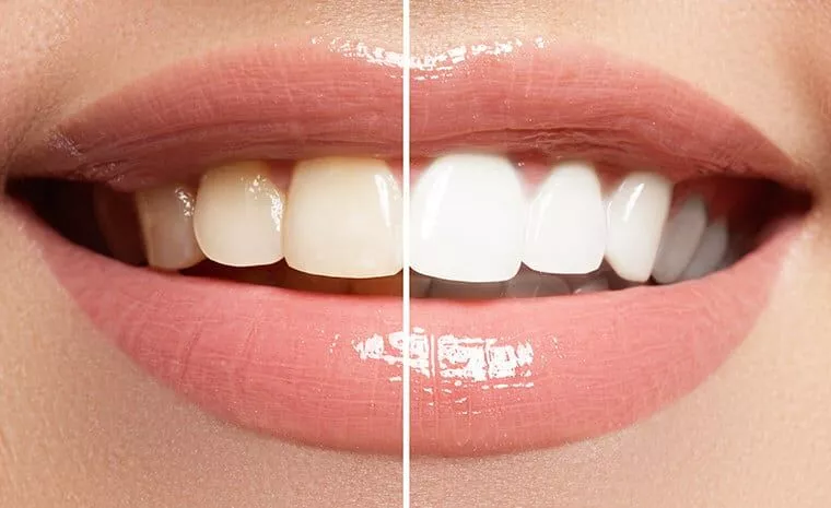 You are currently viewing  5 Effective Teeth Whitening Home Remedies
