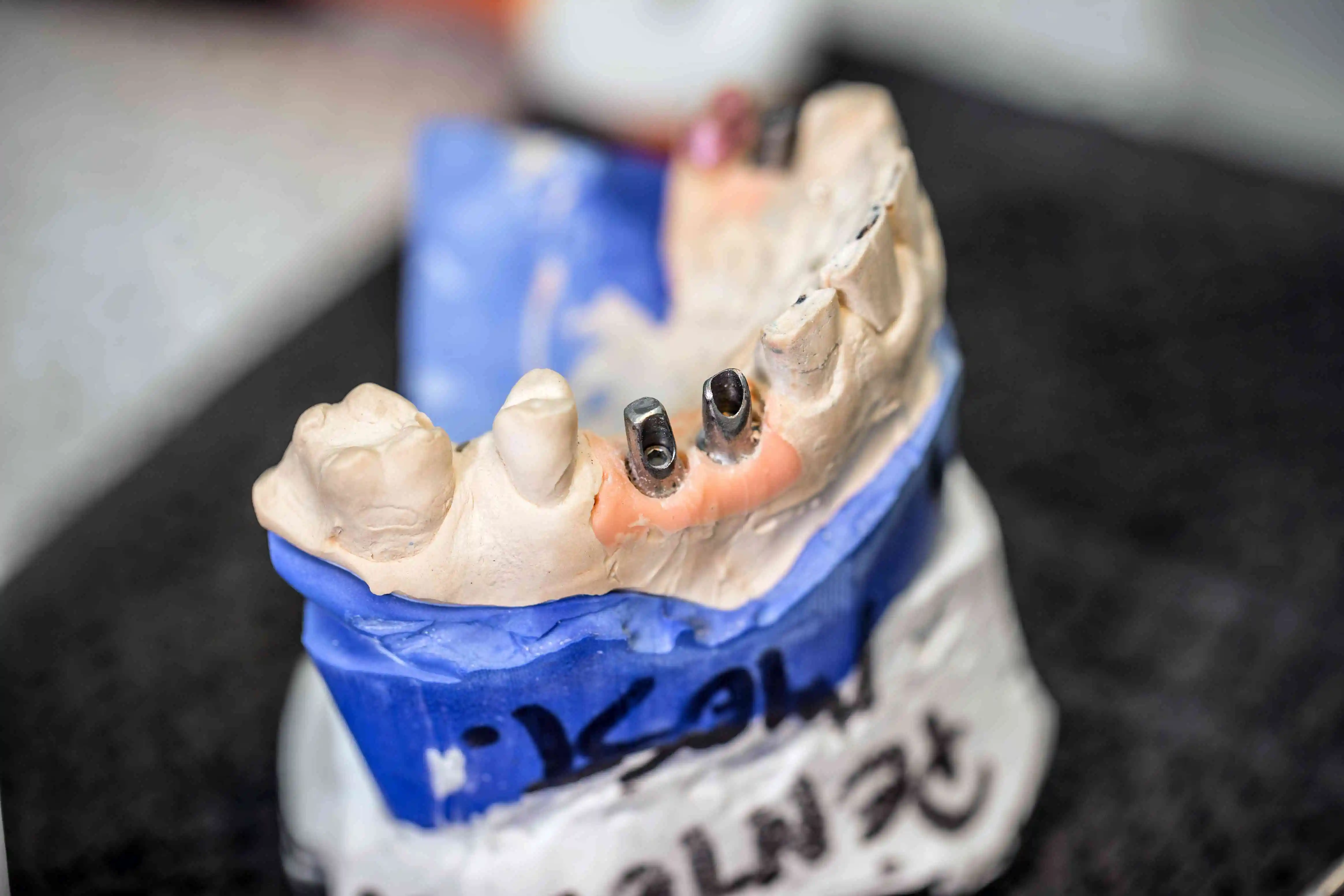 replace missing tooth with dental implant