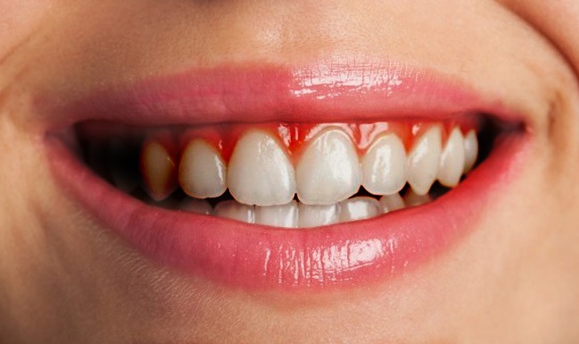 Bleeding Gums Treatments