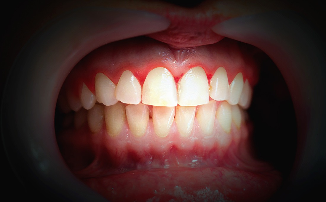 teeth Bleeding Gums