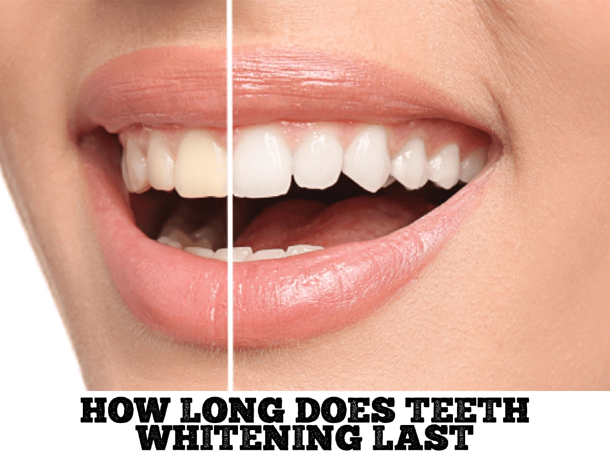 How long does teeth whitening last
