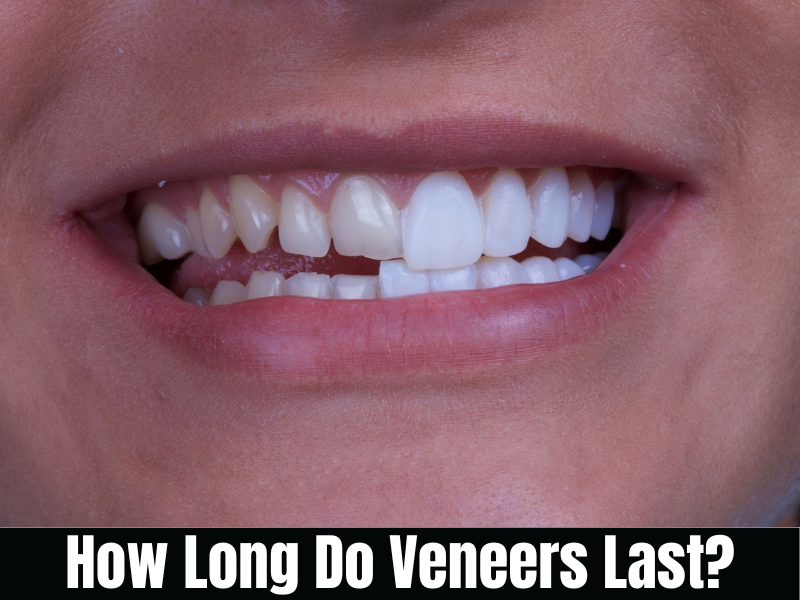 You are currently viewing How Long Do Veneers Last?