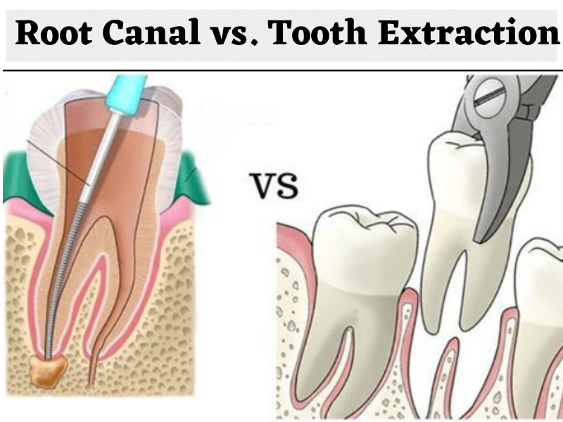 Root Canal vs. Extraction