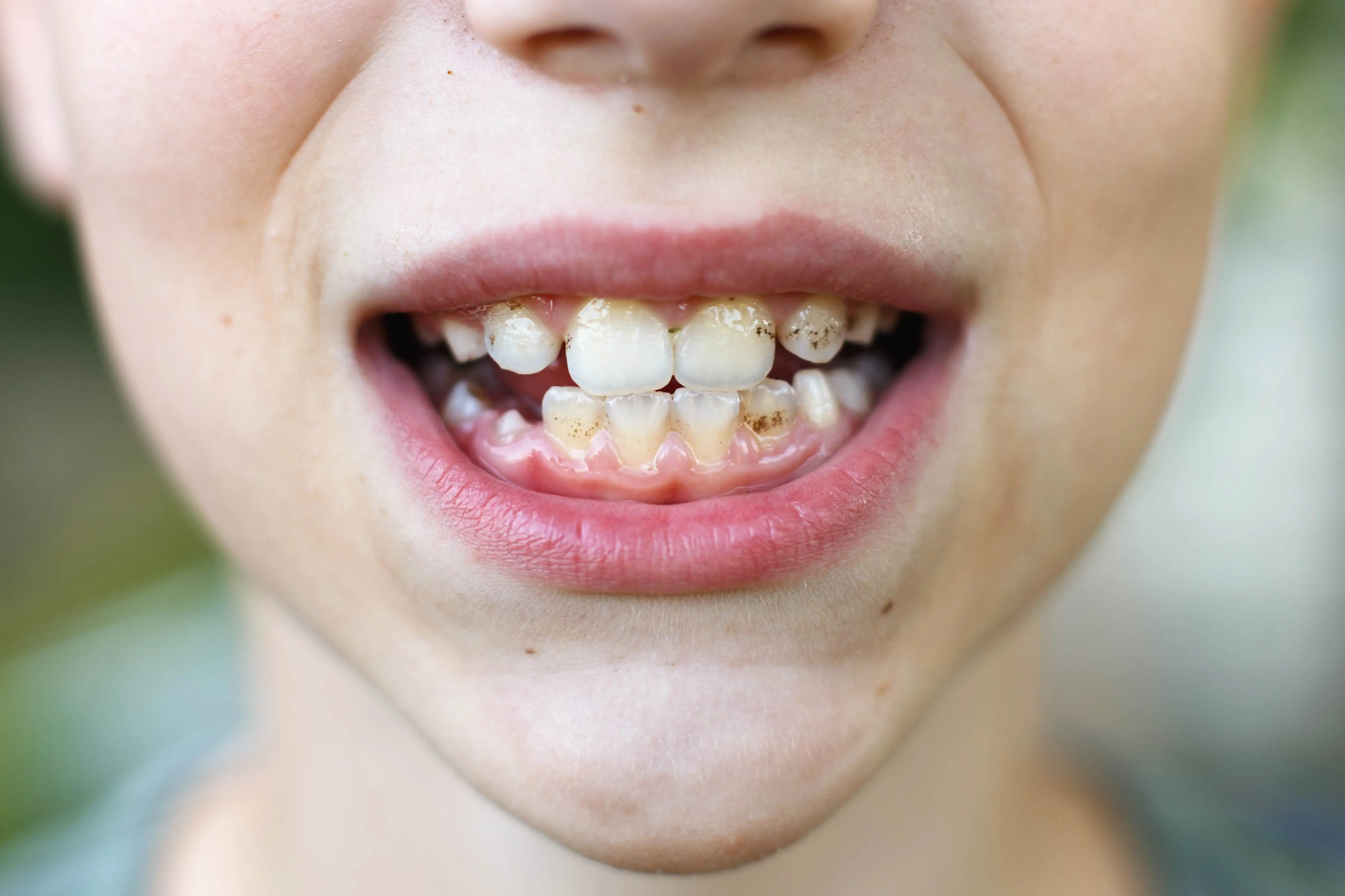 Signs of Poor Oral Hygiene
