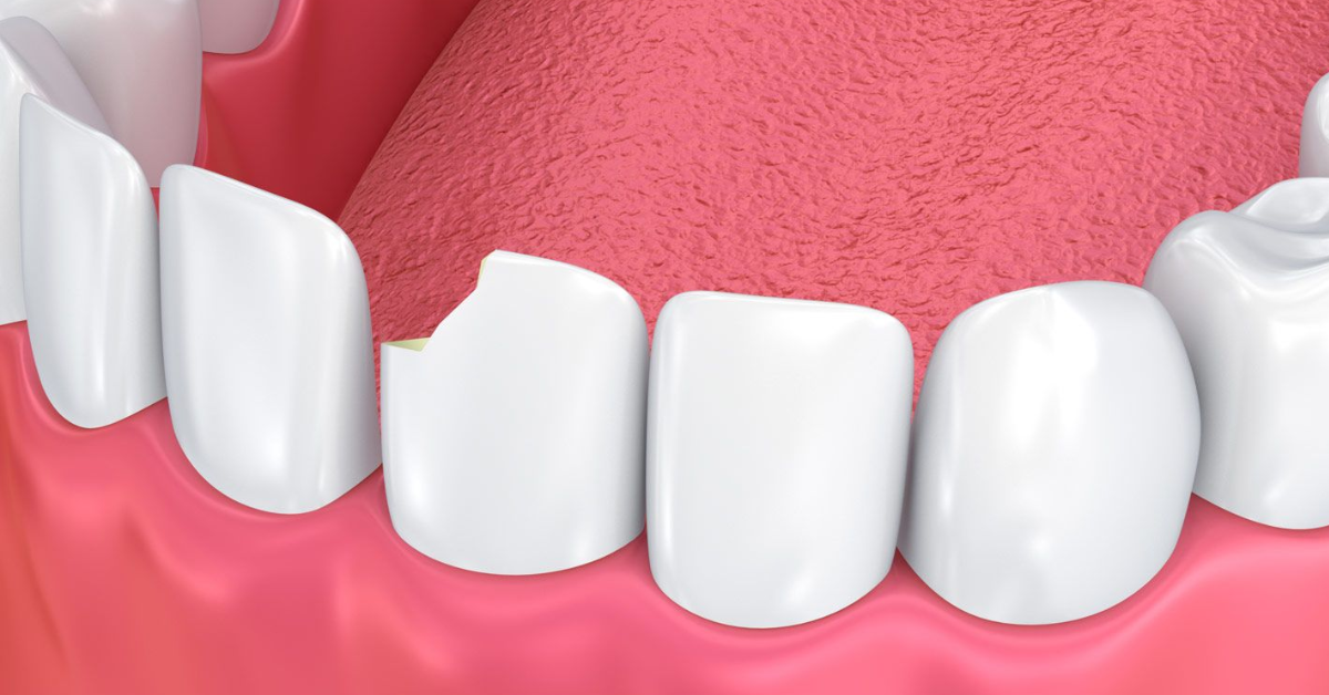 Teeth Susceptible to Chipping