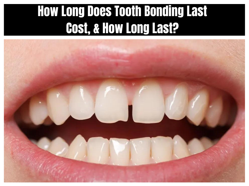 How Long Does Tooth Bonding Last Cost How Long Last