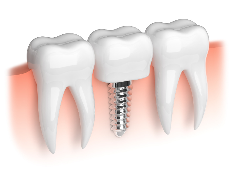 What is the Difference Between a Dental Implant & a Mini Implant