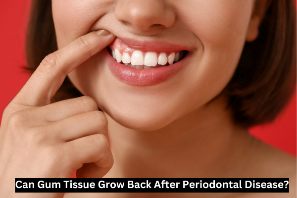 Can Gum Tissue Grow Back After Periodontal Disease
