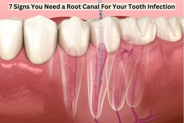 7 Signs You Need a Root Canal For Your Tooth Infection