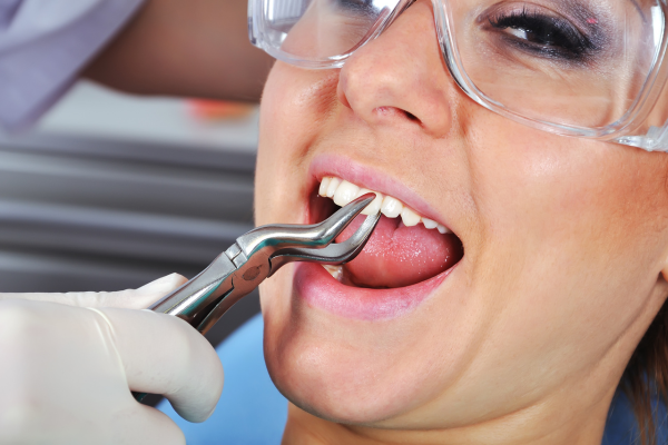 What to Expect During the Tooth Extraction Procedure
