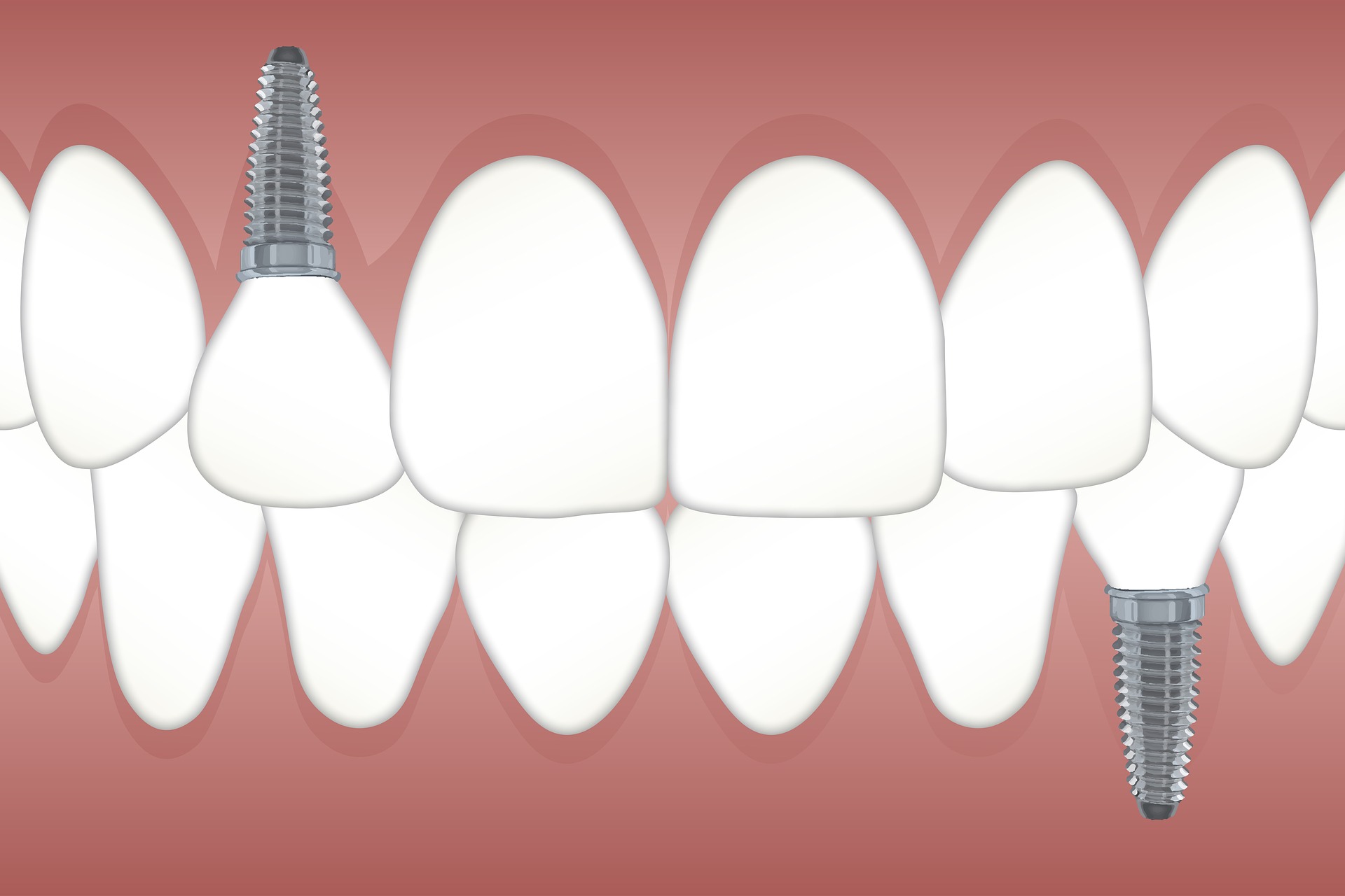 Read more about the article Things You Should Know about Dental Implant Recovery Process