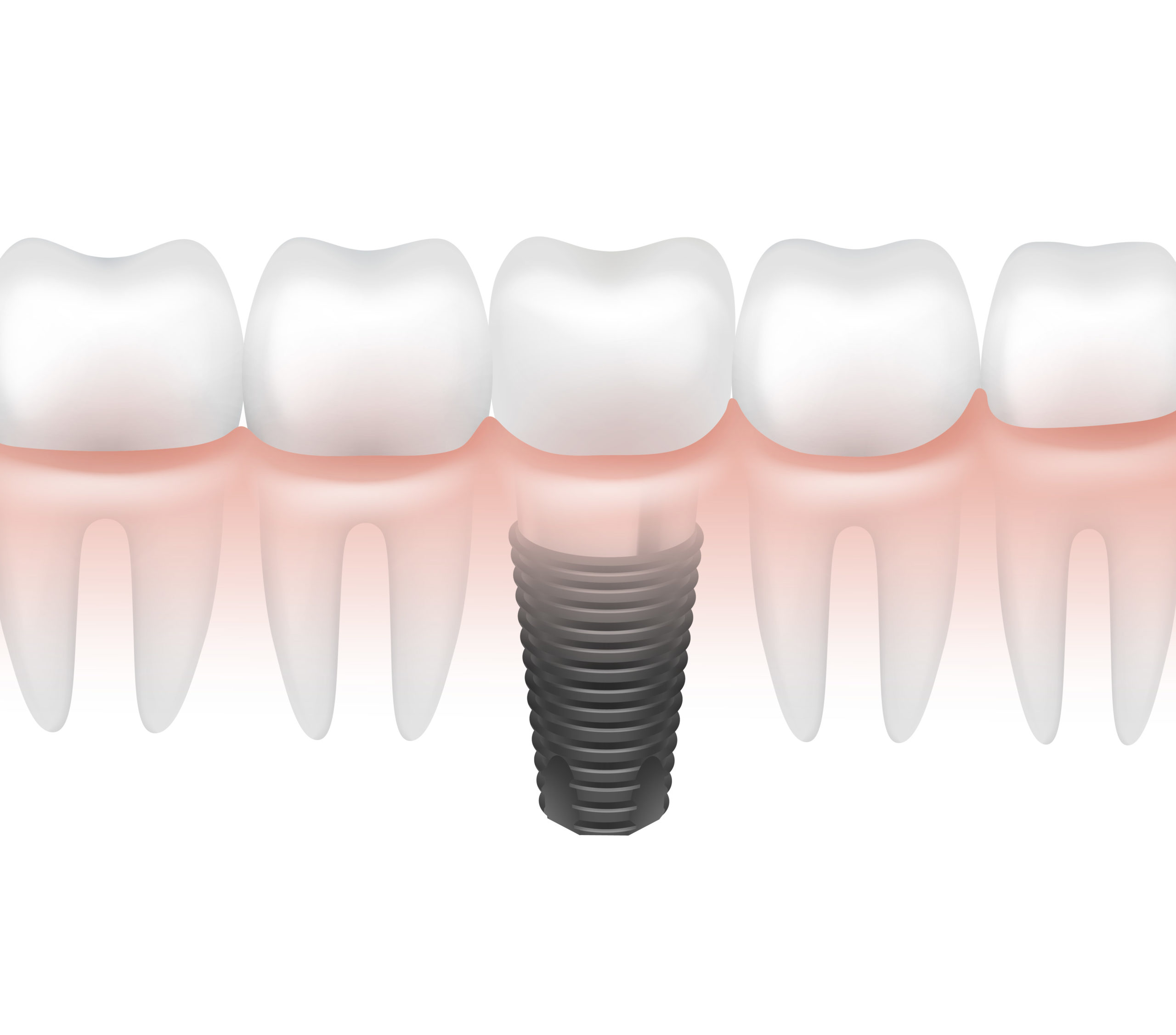 You are currently viewing What You Should Expect During a Single Tooth Implant