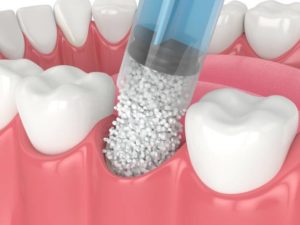 Dental Bone Graft