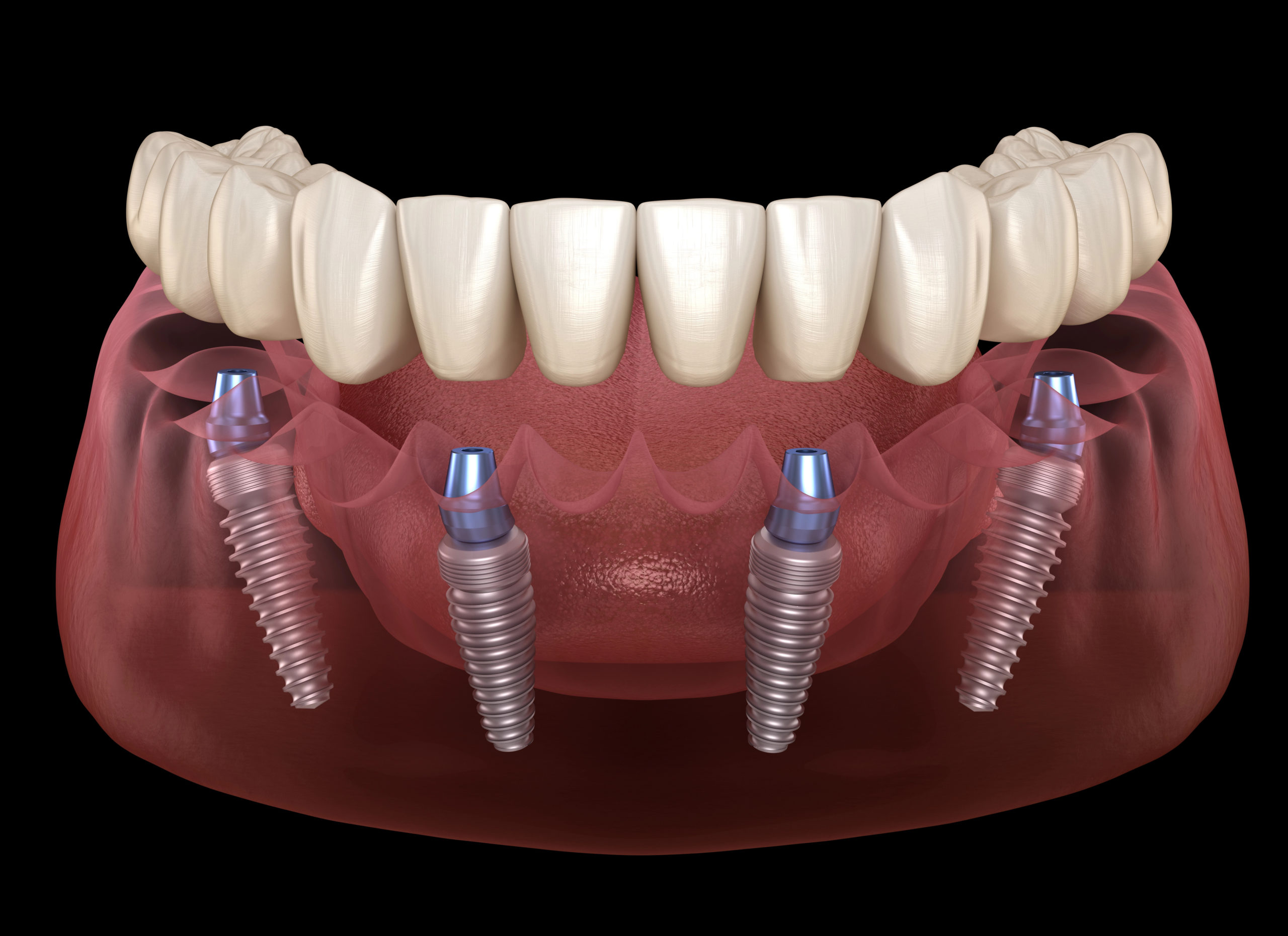 all on 4 dental implants