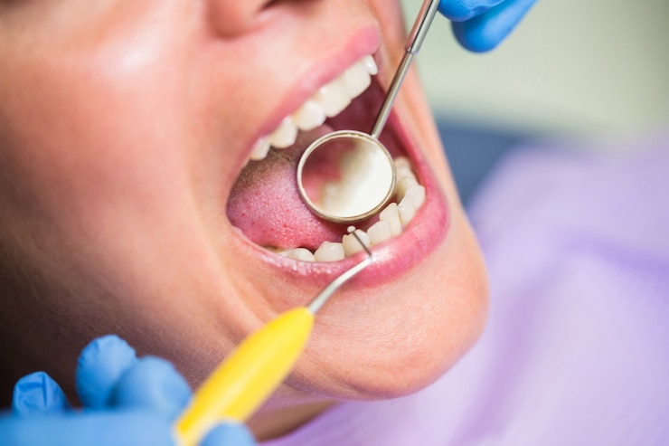 Read more about the article How Long Do Dental Fillings Last? Lifespan by Type and Care Tips.