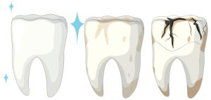 tooth cracked in half no pain