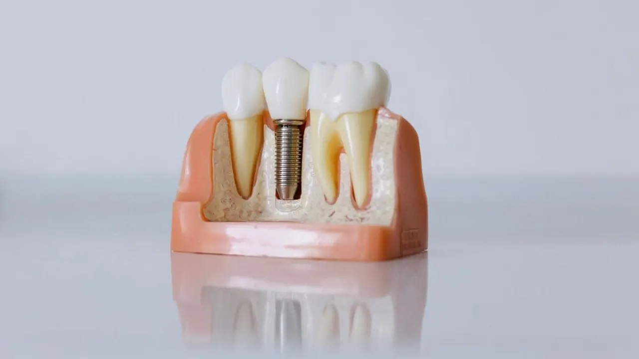 Read more about the article Types of Dental Implants Explained: Which Option Is Right for You?